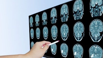 É importante ressaltar que os sintomas da afasia podem variar de pessoa para pessoa, e que cada indivíduo pode apresentar diferentes graus de dificuldade em diferentes áreas da linguagem.