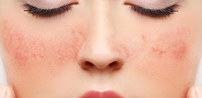 Quando sua pele decide ter uma crise de irritação, o soro fisiológico é como uma sessão de yoga para ela. Ele acalma, refresca e reduz a vermelhidão, trazendo paz e equilíbrio para o seu rosto. Sua pele vai agradecer e você vai se sentir uma verdadeira deusa zen!