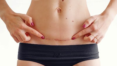 Para aquelas cicatrizes teimosas que insistem em ficar, apresento-lhes o óleo de rosa mosqueta. Sua habilidade em auxiliar na regeneração da pele pode transformar até as cicatrizes mais persistentes em memórias suaves.