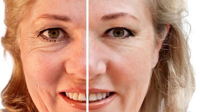 E quem disse que o tempo não pode ser gentil conosco? O óleo de rosa mosqueta é conhecido por ajudar a reduzir a aparência de rugas, mantendo nossa pele com um aspecto jovem e vibrante. Uma verdadeira fórmula contra o envelhecimento!